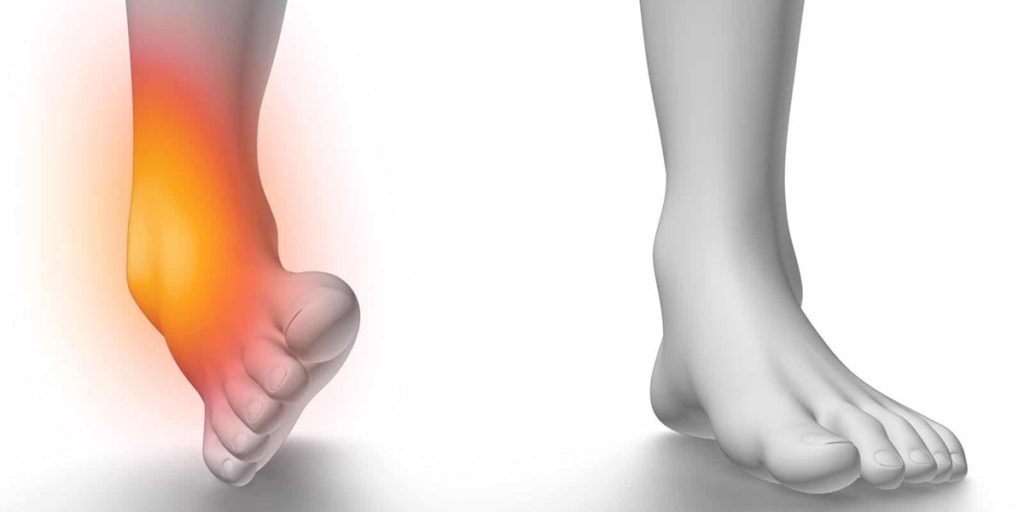 درمان پیچ خوردگی مچ پا با زردچوبه|درمان پیچ خوردگی مچ پا با زردچوبه|