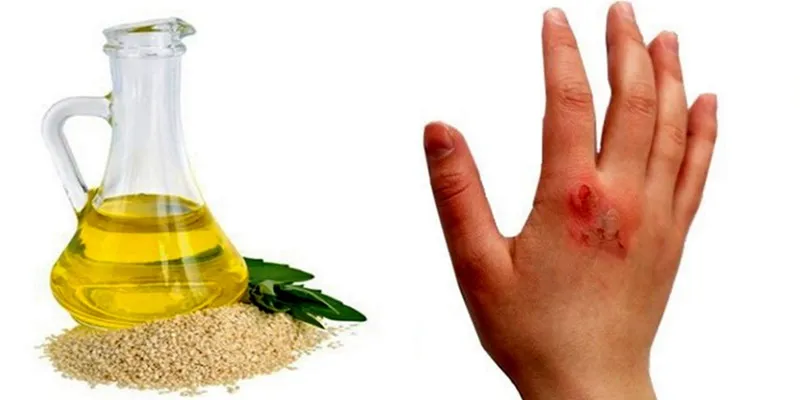 روغن ارده کنجد برای سوختگی|روغن ارده کنجد برای سوختگی